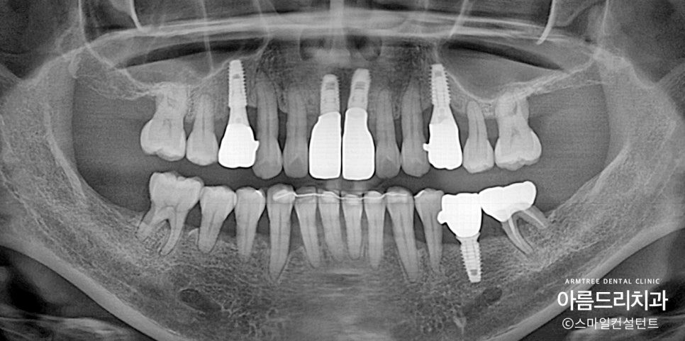왜 임플란트와 치아교정을 다 잘아는 곳에서 치료해야할까?| 아름드리치과 진료일기 관련 이미지 3