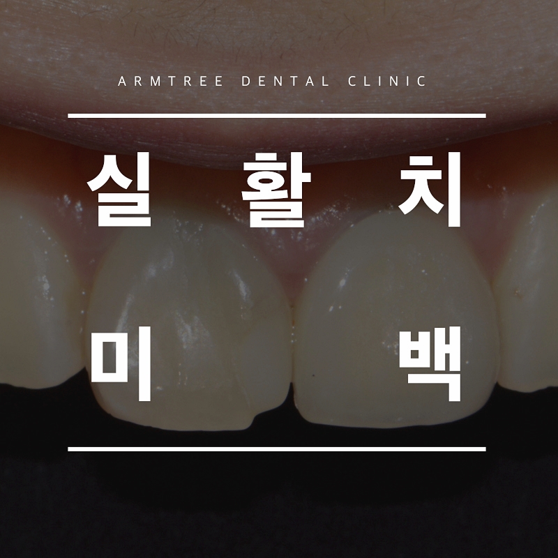 실활치미백 앞니변색 후기는 관련 이미지 1