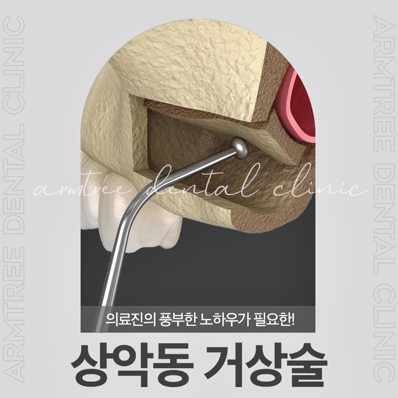 상악동거상술 임플란트가 필요하다면 관련 이미지 1