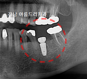 치아 통증은 있는데 이상은 없다?(재식, 임플란트_아름드리 치과) 관련 이미지 9