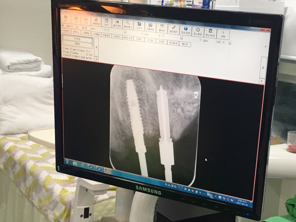 앞니 임플란트_뼈이식_신논현역 치과_아름드리 치과 관련 이미지 21