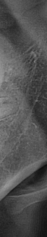 반포치과 사랑니발치 치과를 찾고있다면 관련 이미지 13