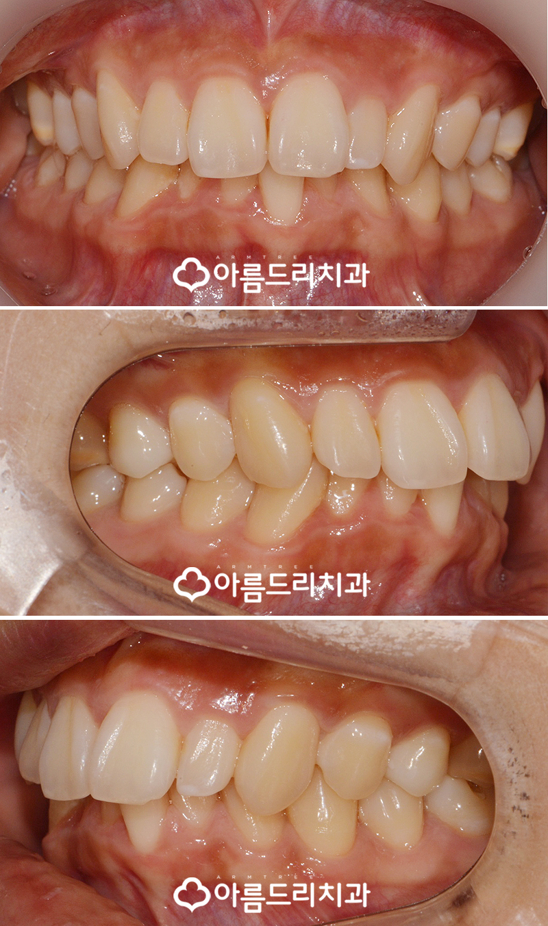 급속치아교정 코티코토미 피질골절단술 후기 관련 이미지 4