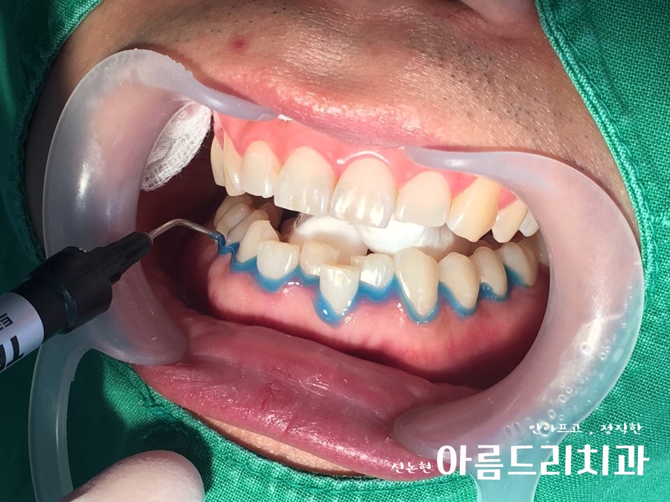 신논현역치과 아름드리치과에서 건강한 치아미백, 전문가 미백 관련 이미지 6
