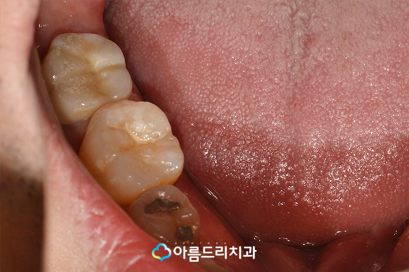 치아재식술 자연치아를지키는 방법 관련 이미지 11