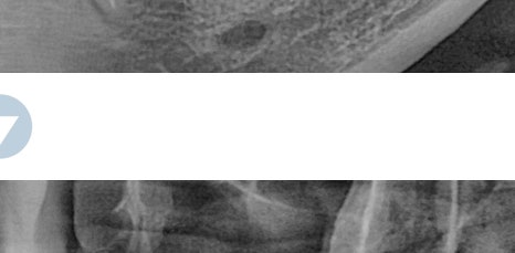 신논현역임플란트 아름드리치과에서 상악동거상술이 필요하면 관련 이미지 11