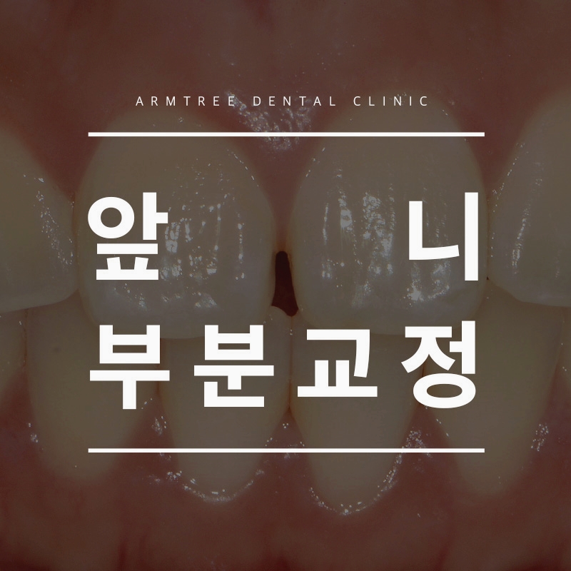 벌어진앞니부분교정 후기로 아름드리치과에서 자신감찾기 관련 이미지 1