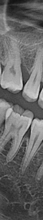 반포치과 사랑니발치 치과를 찾고있다면 관련 이미지 7