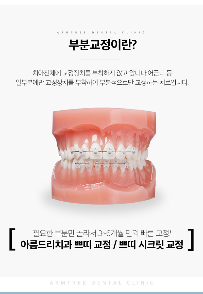 앞니부분교정 꼼꼼하고 예리하게 관련 이미지 6