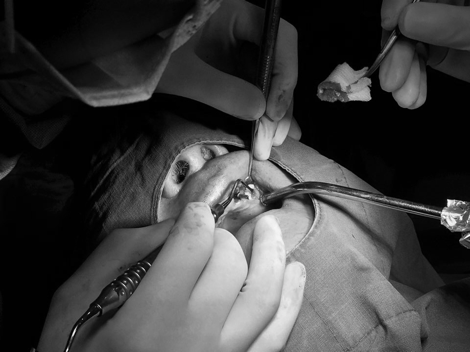 앞니 임플란트_뼈이식_신논현역 치과_아름드리 치과 관련 이미지 1