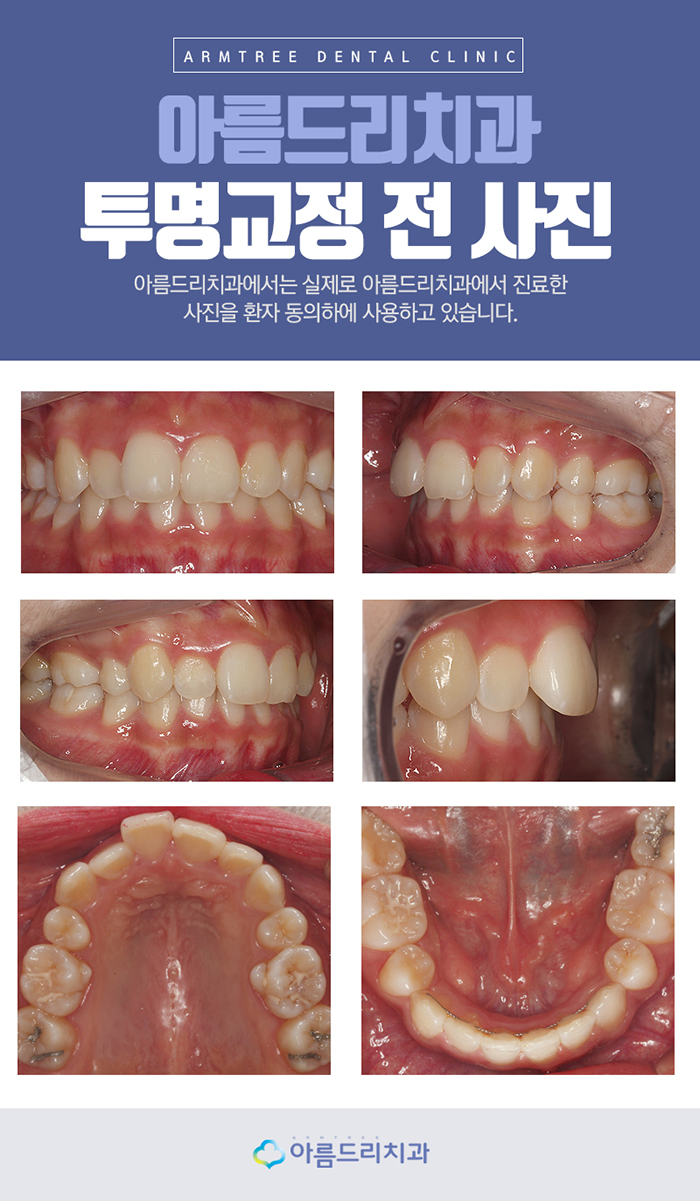 연예인투명교정 놀라워 관련 이미지 5