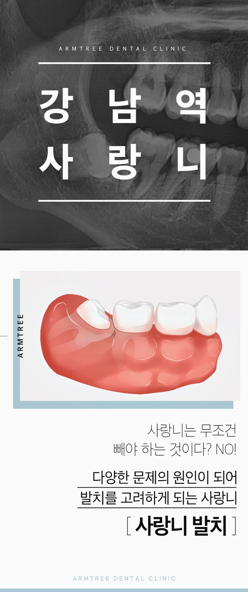 강남역사랑니 발치 통증없이 가능하면 관련 이미지 1