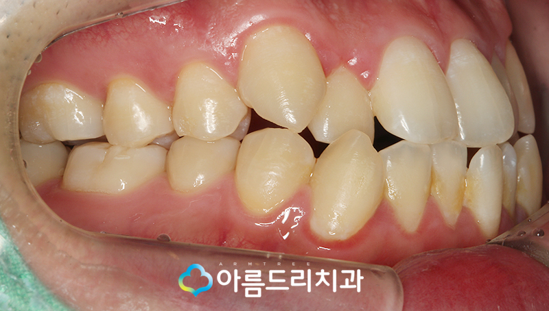 투명교정장치 인비절라인 치과 후기 관련 이미지 5