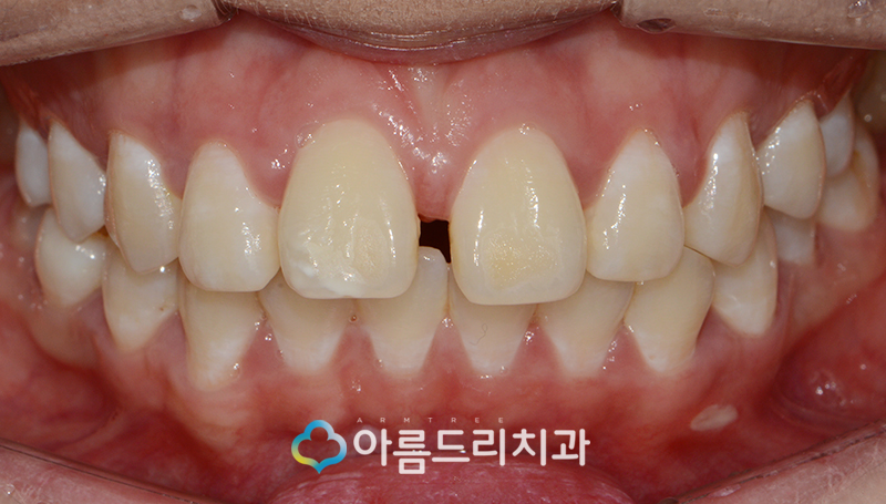 라미네이트부작용 걱정은노 관련 이미지 3