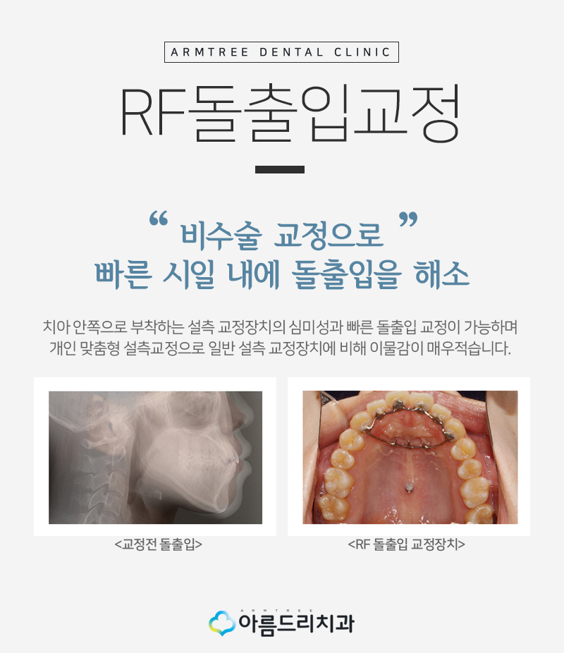 입툭튀교정 돌출앞니 환자후기 관련 이미지 4