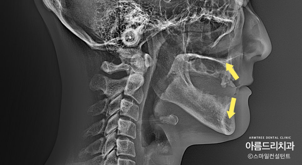 전체임플란트 전악임플란트 전후 아름드리치과 진료일기 관련 이미지 2