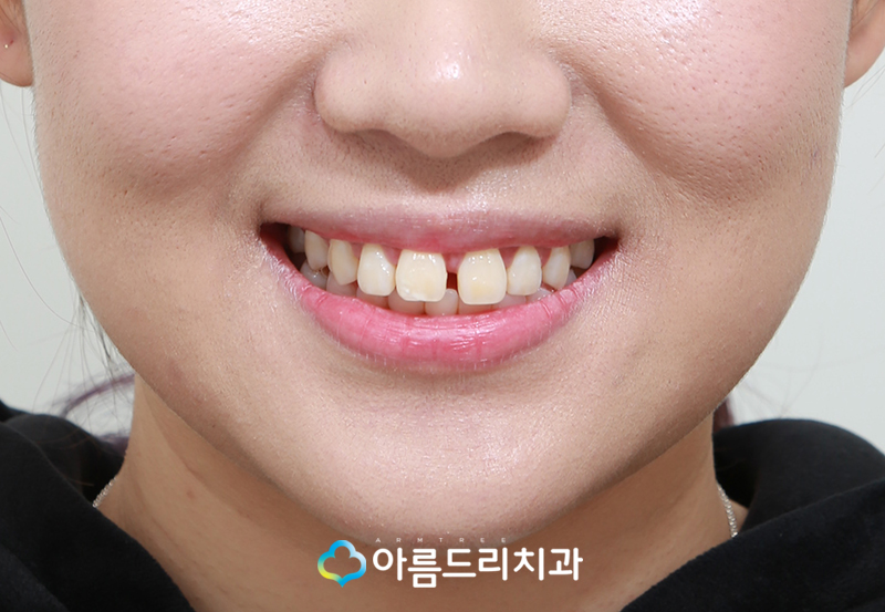 벌어진앞니 앞니라미네이트 치료후기 관련 이미지 4