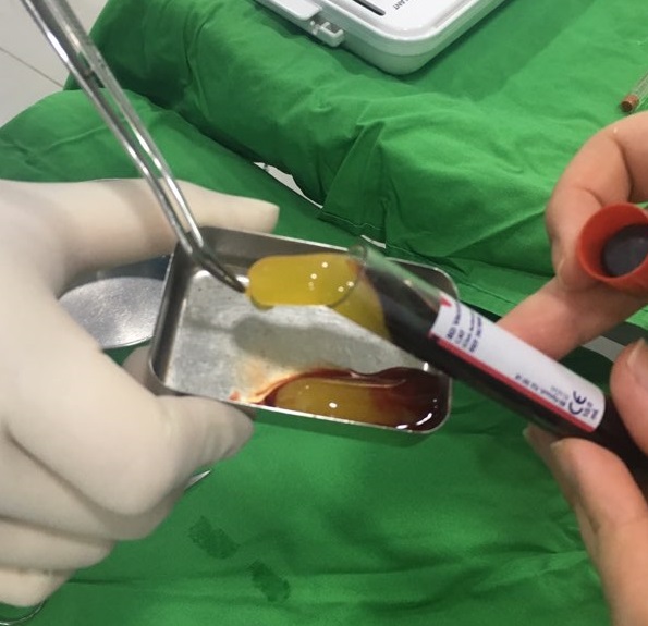 신논현역치과 PRF 자가혈 임플란트. 안전한 임플란트_아름드리 치과 관련 이미지 1