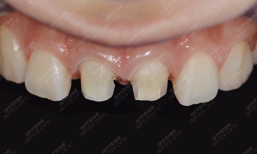 실활치미백 앞니변색 걱정NO! 신논현역 아름드리치과 관련 이미지 8