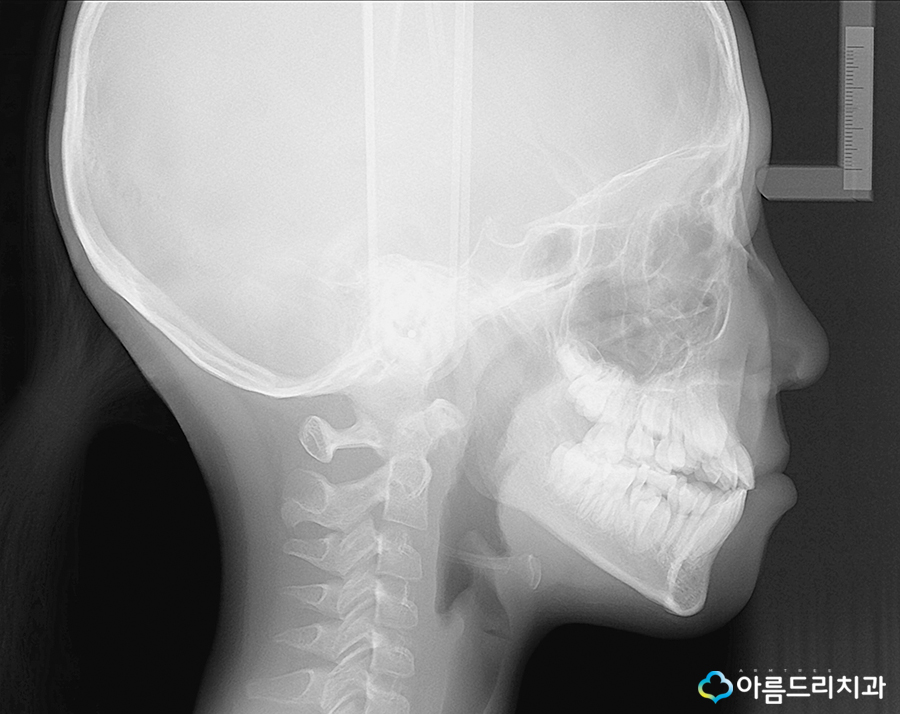 어린이치아교정 부정교합 성장판 검사 관련 이미지 12
