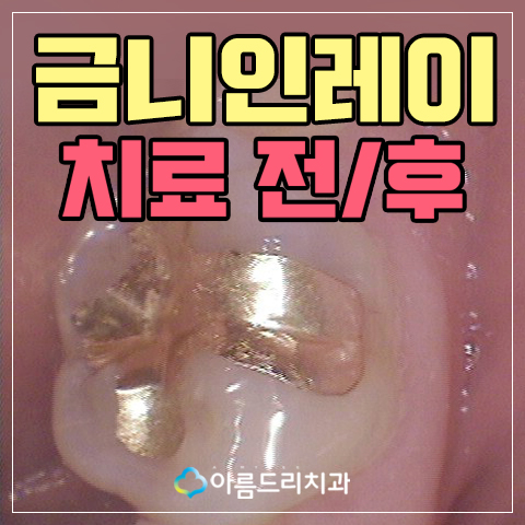 금니 2차충치 생기는 이유와 치료 관련 이미지 1
