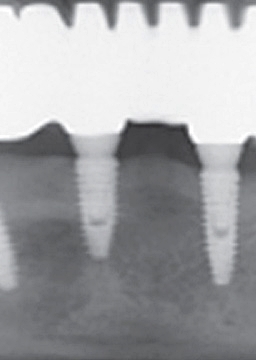 반포치과 전악임플란트는 풀아치 임플란트로 관련 이미지 12