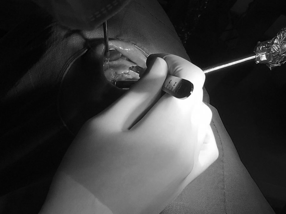 앞니 임플란트_뼈이식_신논현역 치과_아름드리 치과 관련 이미지 4