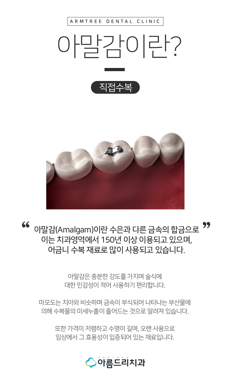 충치인레이 아말감주변 충치치료는? 관련 이미지 6