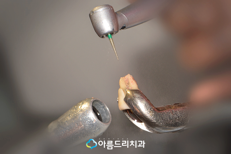 치아재식술 자연치아를지키는 방법 관련 이미지 7