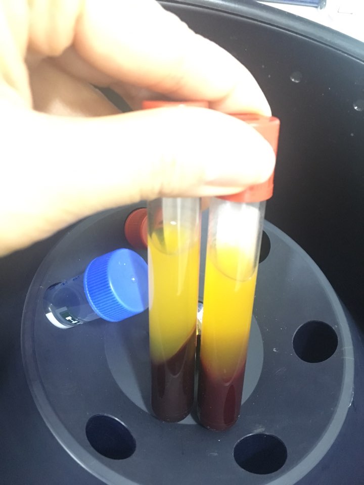 신논현역치과 PRF 자가혈 임플란트. 안전한 임플란트_아름드리 치과 관련 이미지 8