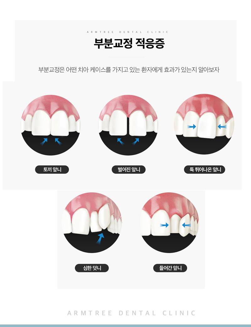 앞니부분교정 꼼꼼하고 예리하게 관련 이미지 9