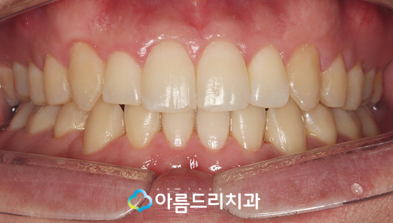 투명교정장치 인비절라인 치과 후기 관련 이미지 9