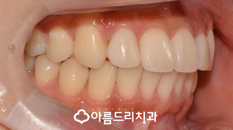 급속치아교정 코티코토미 피질골절단술 후기 관련 이미지 11