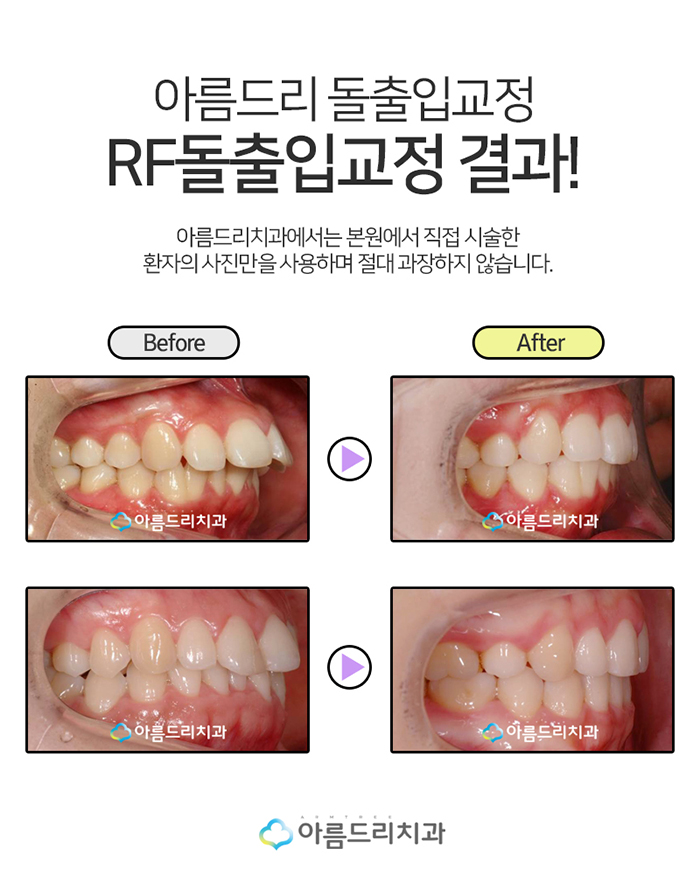 입툭튀교정 돌출앞니교정 도장쾅쾅 관련 이미지 7