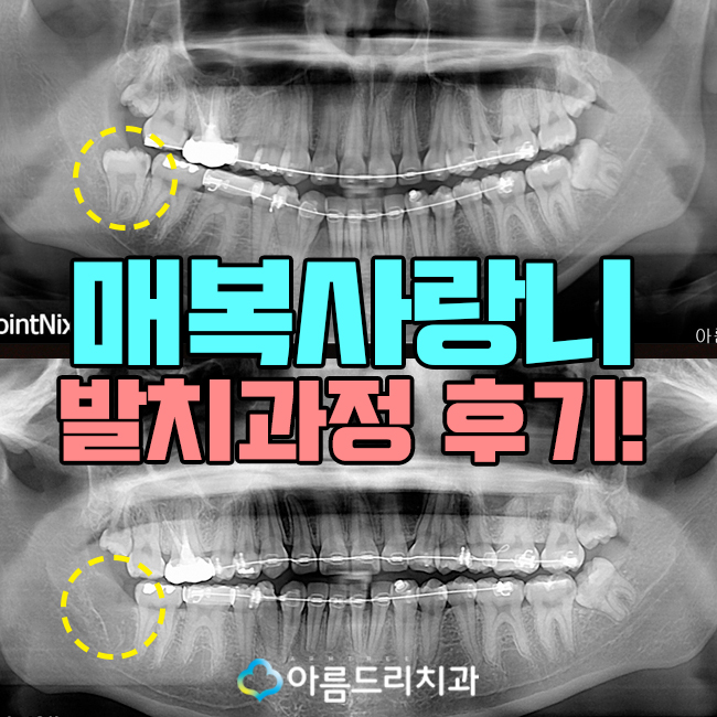 매복사랑니 발치후기 리얼하게 관련 이미지 1