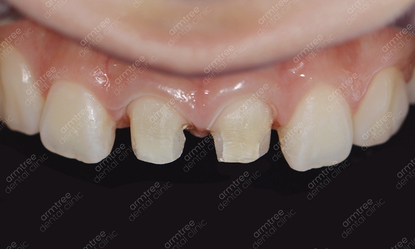 실활치미백 앞니변색 걱정없는 아름드리치과 관련 이미지 8