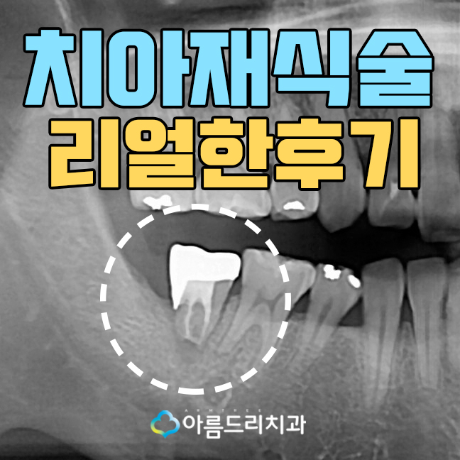 치아재식술 후기 자연치아지키기 관련 이미지 1