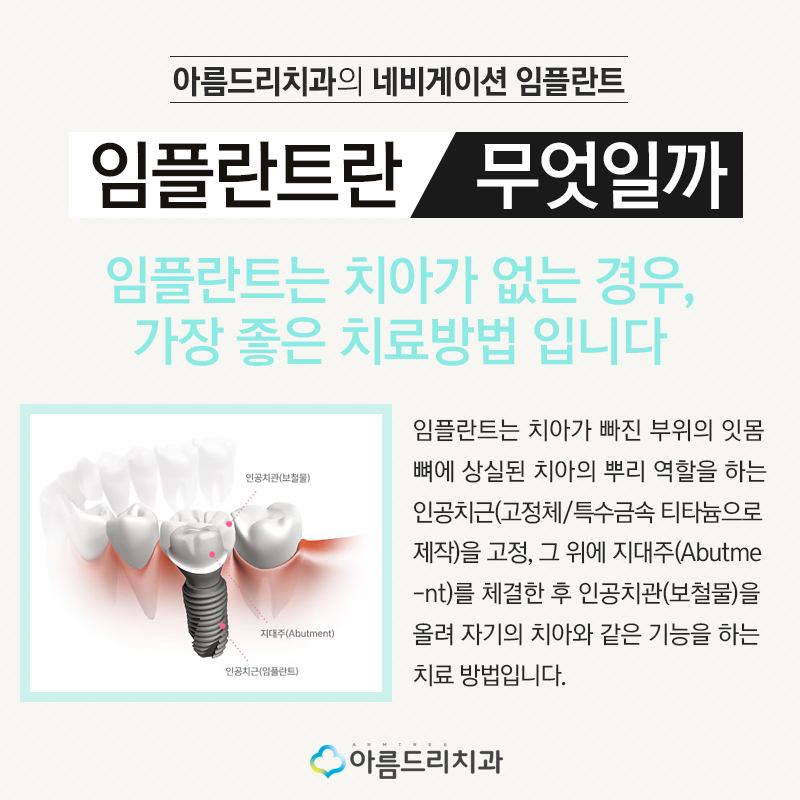 네비게이션 인플란트 기간은 어떻게? 관련 이미지 2