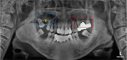 치아를 최대한 보존하는 임플란트 치료 관련 이미지 3