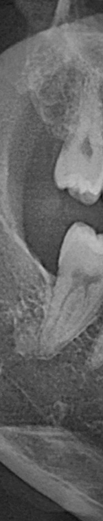 반포치과 사랑니발치 치과를 찾고있다면 관련 이미지 6