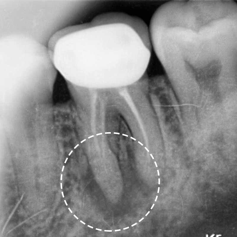 잇몸고름주머니치료 염증제거 아름드리치과 관련 이미지 1