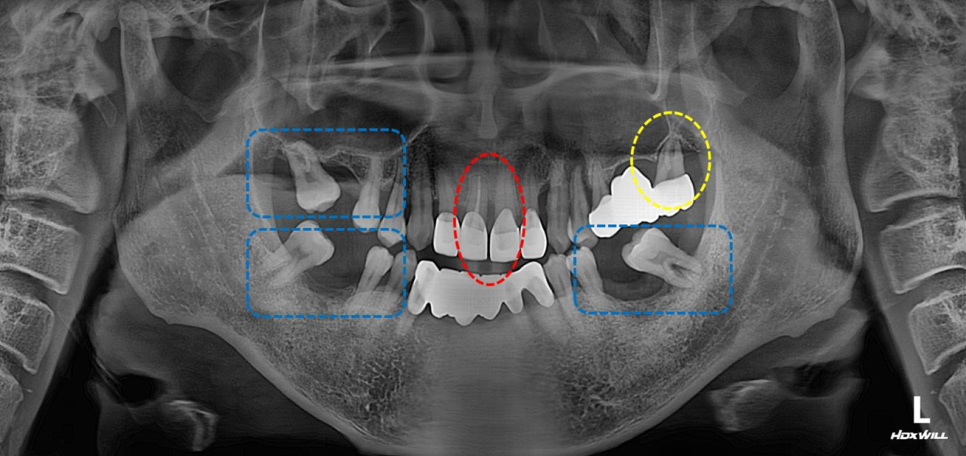 치아를 최대한 보존하는 임플란트 치료 관련 이미지 1