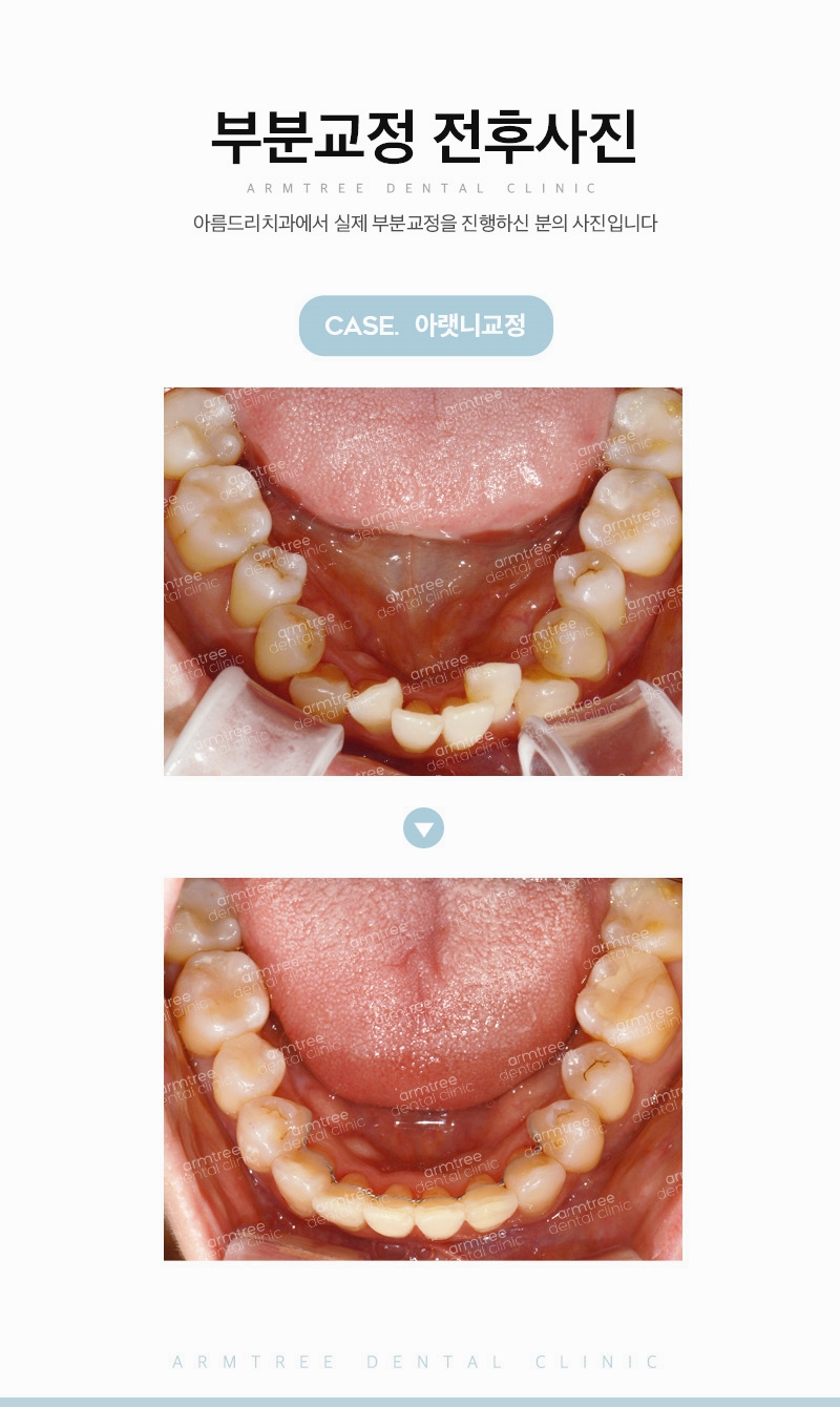 아랫니부분교정 아랫니만 가능한 아름드리치과 관련 이미지 12