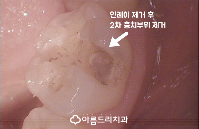 금니 2차충치 생기는 이유와 치료 관련 이미지 6