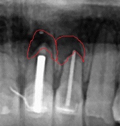 뽑지 않고 자가치아를 살려주세요_치아 뿌리수술_치근단절제술+뼈이식 관련 이미지 6