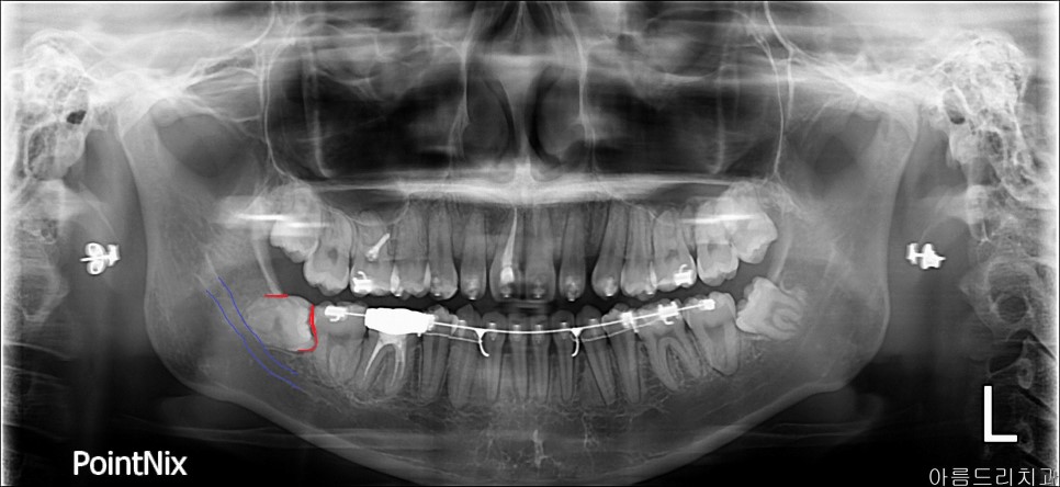 강남 아름드리치과 수술 발치_매복치 신논현치과 관련 이미지 4