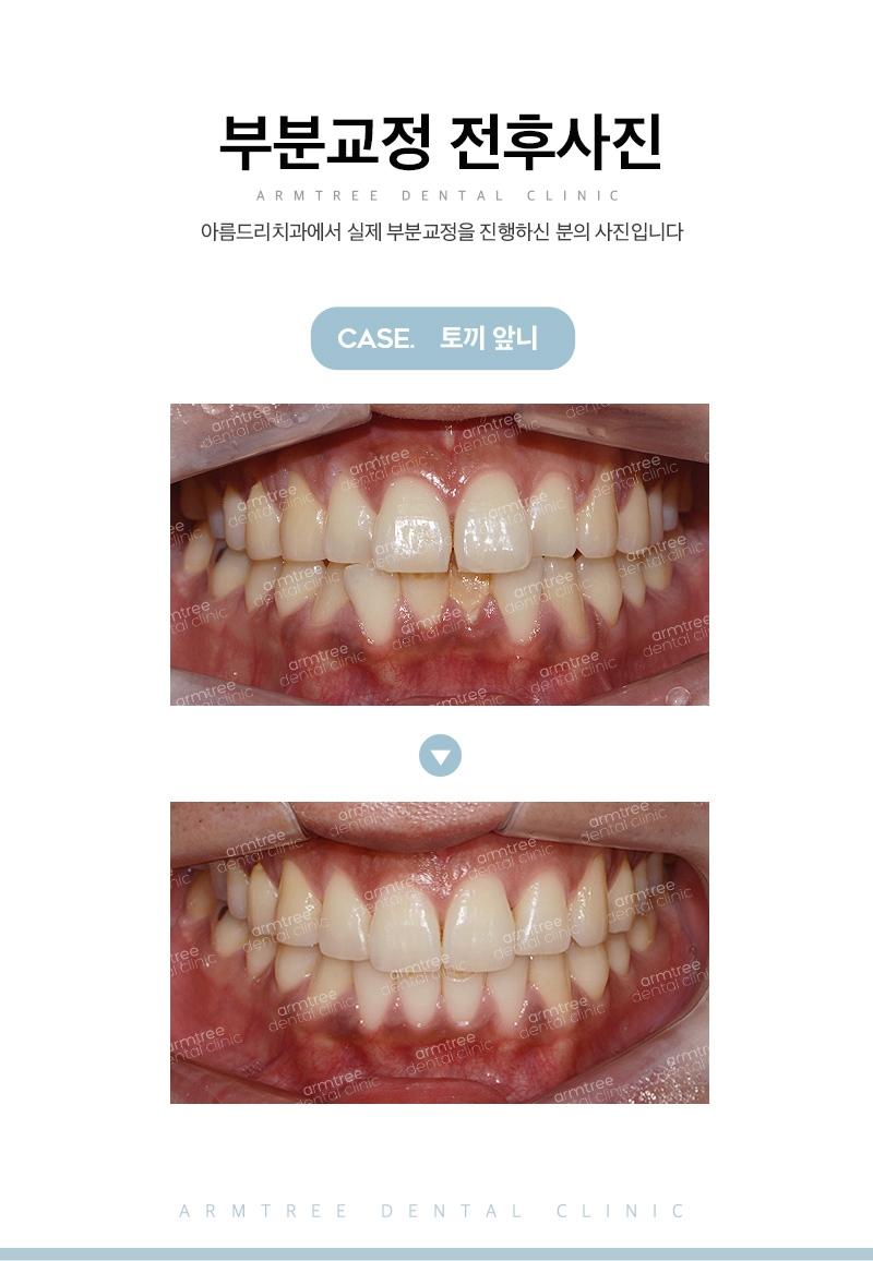 벌어진앞니부분교정 신논현역 아름드리치과 관련 이미지 12