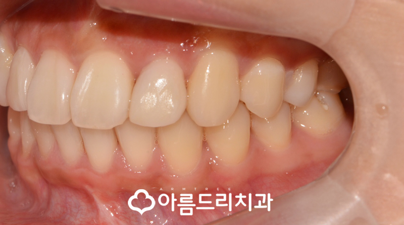 급속치아교정 코티코토미 피질골절단술 후기 관련 이미지 12