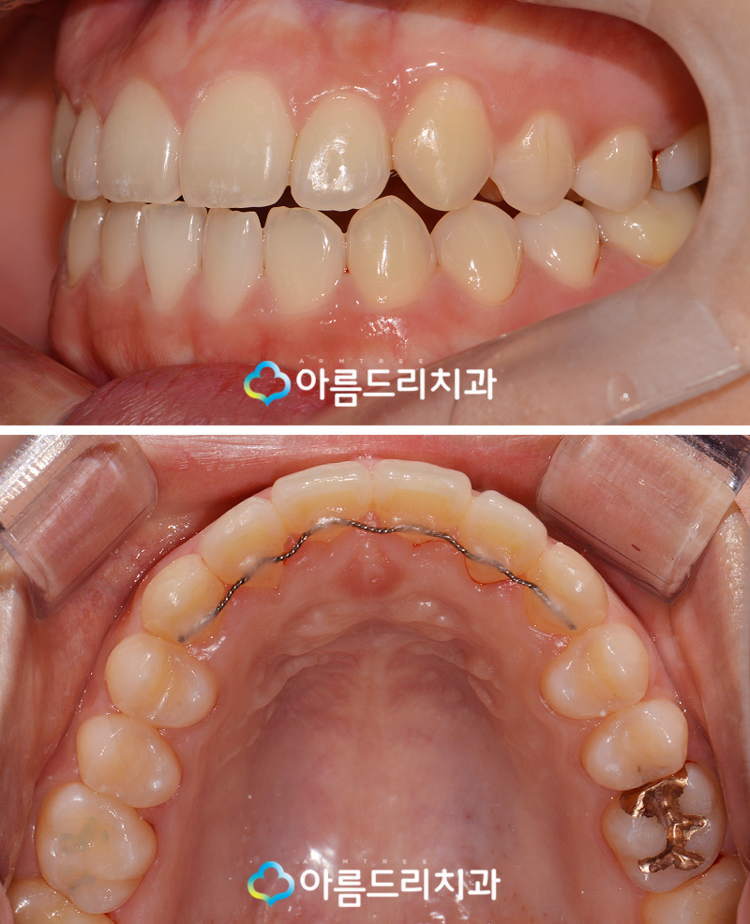 덧니교정 빠르게 부분만 관련 이미지 8