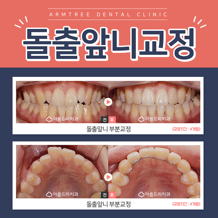돌출앞니부분교정 제대로 알자 관련 이미지 1